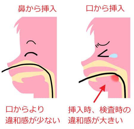 内視鏡検査方法 (鼻・口)